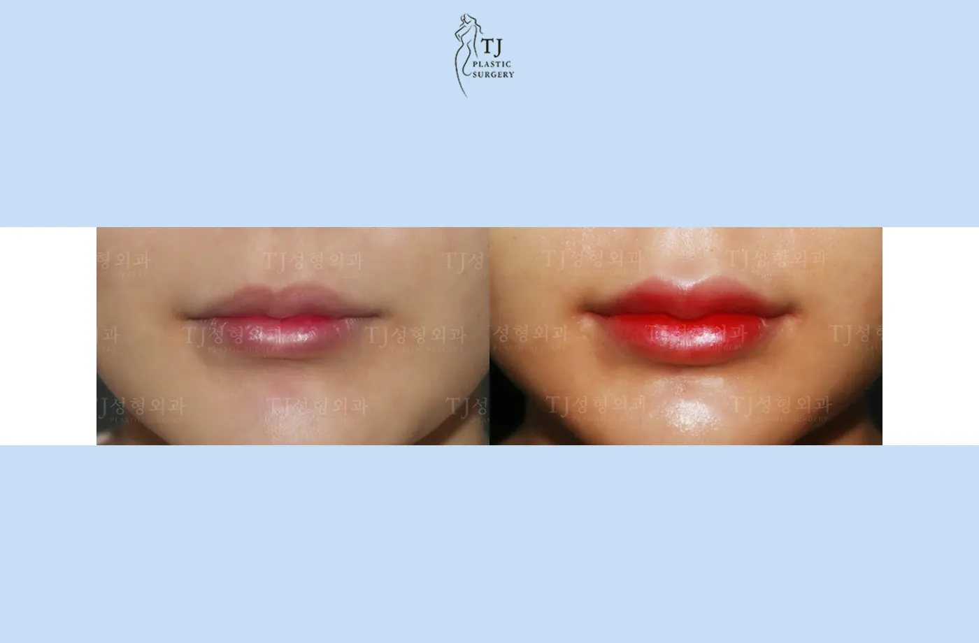 Lip fillers at TJ Plastic Surgery Clinic — Front view; before on the left · after on the right