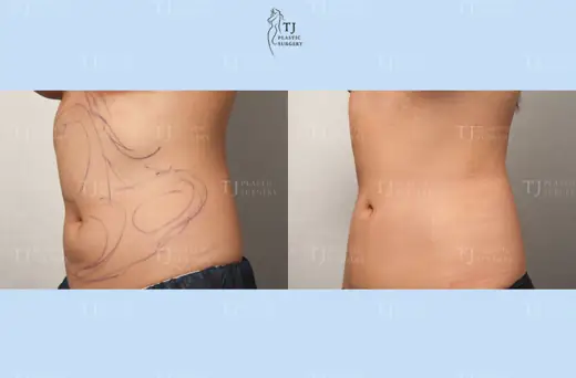 Liposuction — side view of the abdomen and flanks before and after at TJ Plastic Surgery Clinic