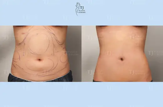 Liposuction — front view of the abdomen and flanks before and after at TJ Plastic Surgery Clinic
