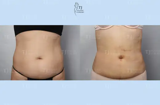 Liposuction — front view of the abdomen before and after at TJ Plastic Surgery Clinic