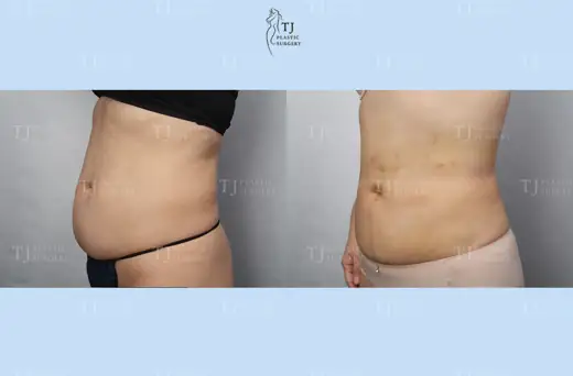 Liposuction — side view of the abdomen before and after at TJ Plastic Surgery Clinic