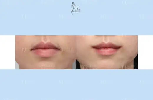 Mouth corner surgery — front view before and after at TJ Plastic Surgery Clinic