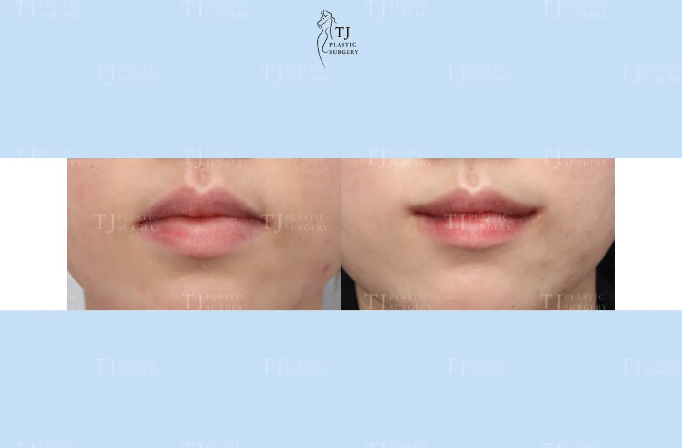 Mouth corner surgery at TJ Plastic Surgery Clinic — Front view; before on the left · after on the right
