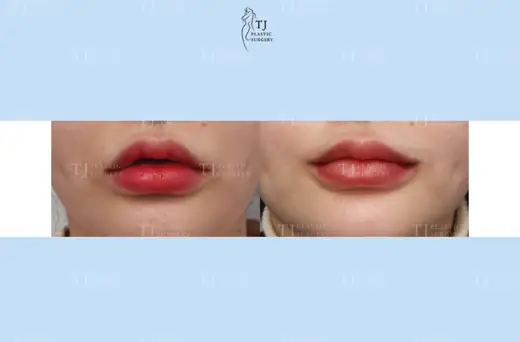 Mouth corner surgery — front view before and after at TJ Plastic Surgery Clinic