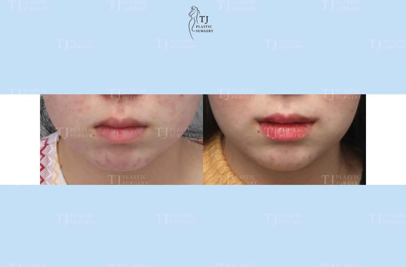 Mouth corner surgery at TJ Plastic Surgery Clinic — Front view; before on the left · after on the right