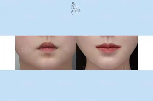 Mouth corner surgery — front view before and after at TJ Plastic Surgery Clinic