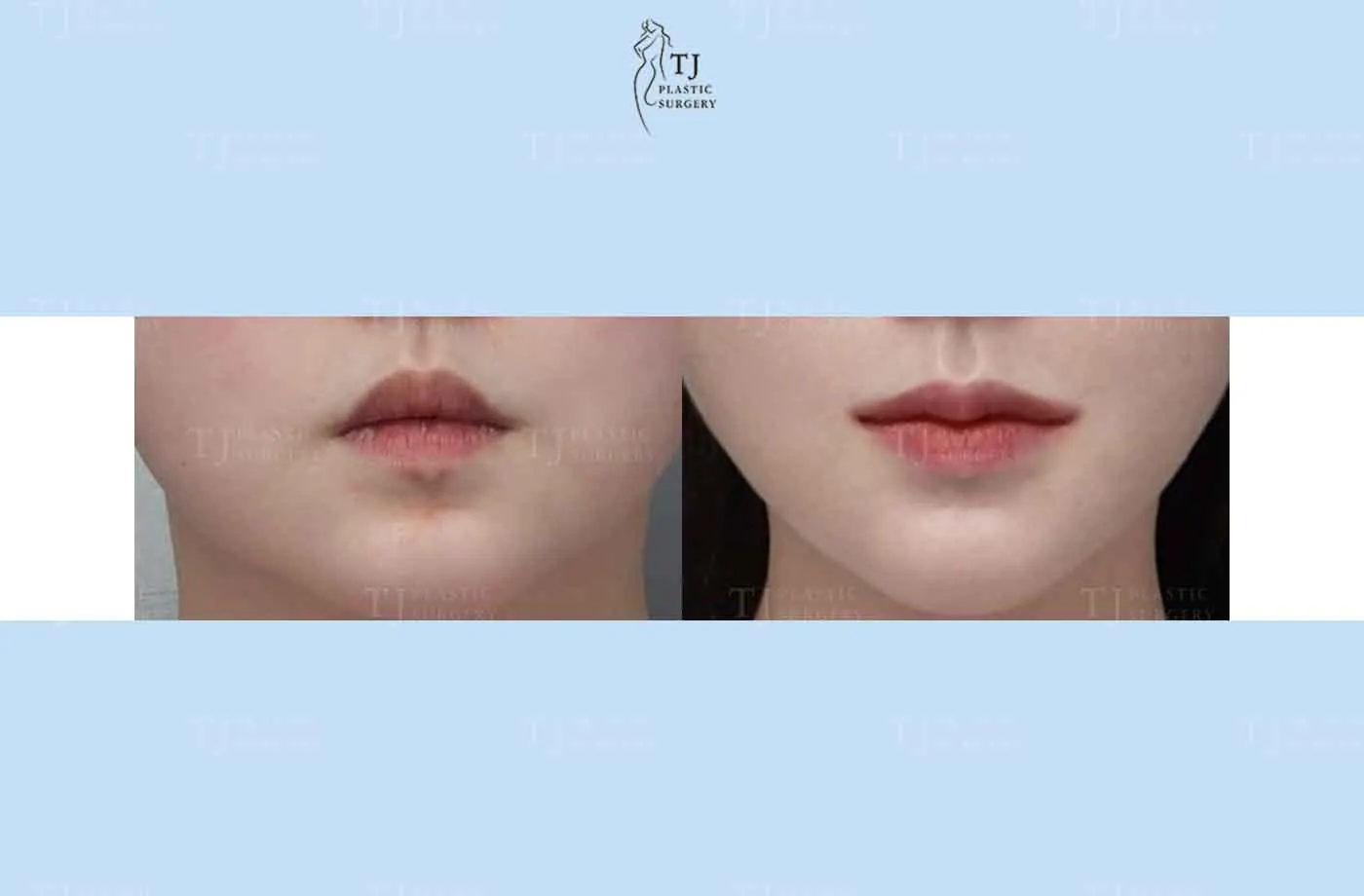 Mouth corner surgery at TJ Plastic Surgery Clinic — Front view; before on the left · after on the right