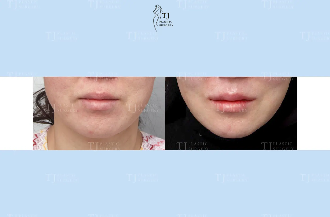 Mouth corner surgery at TJ Plastic Surgery Clinic — Front view; before on the left · after on the right
