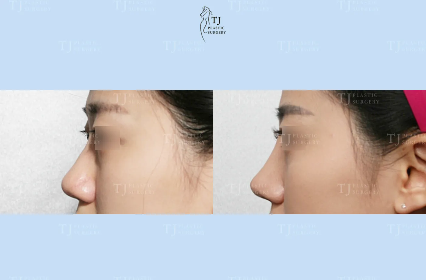 Rhinoplasty at TJ Plastic Surgery Clinic — Side view; before on the left · after on the right