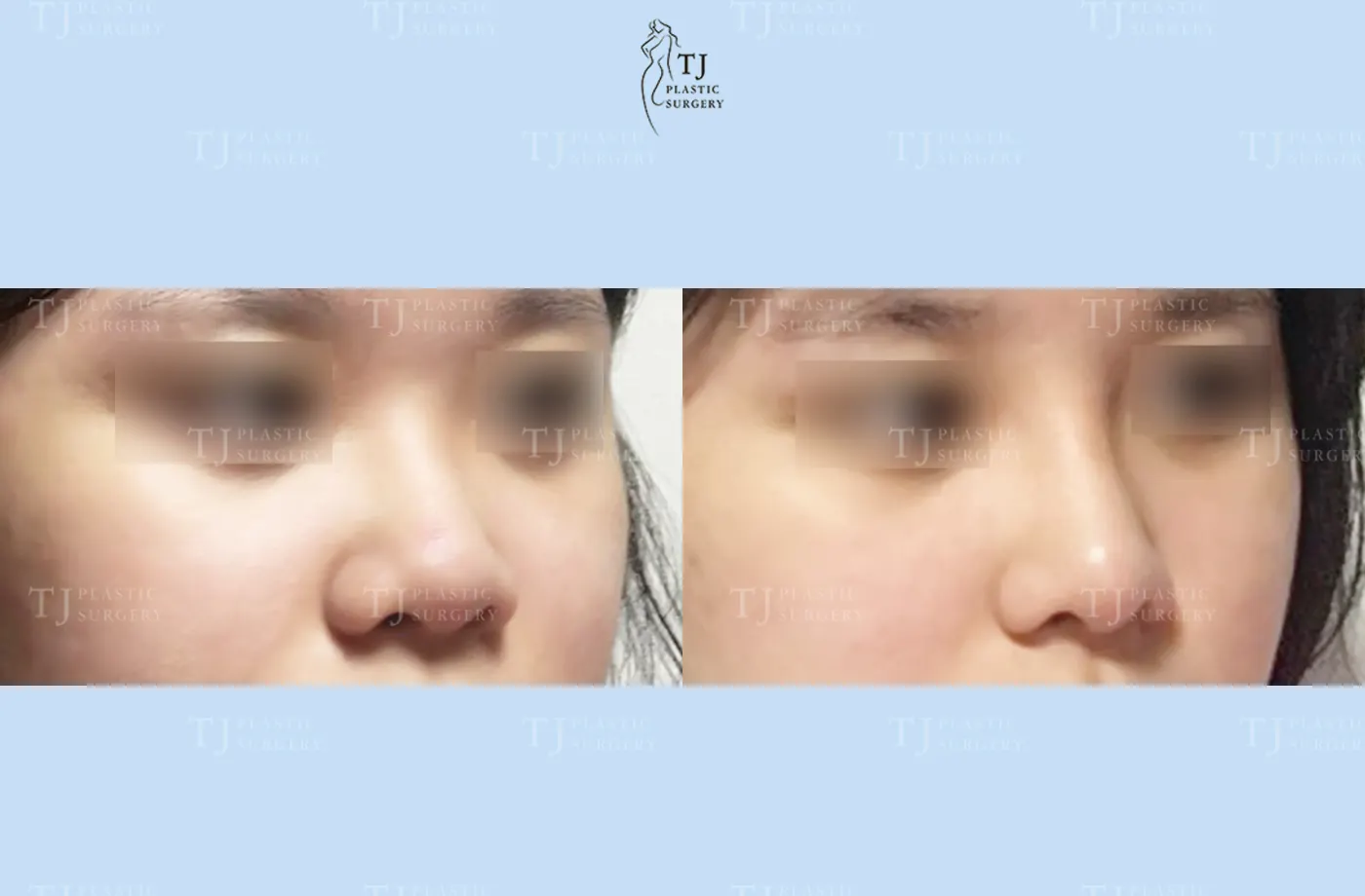 Rhinoplasty at TJ Plastic Surgery Clinic — Front view; before on the left · after on the right