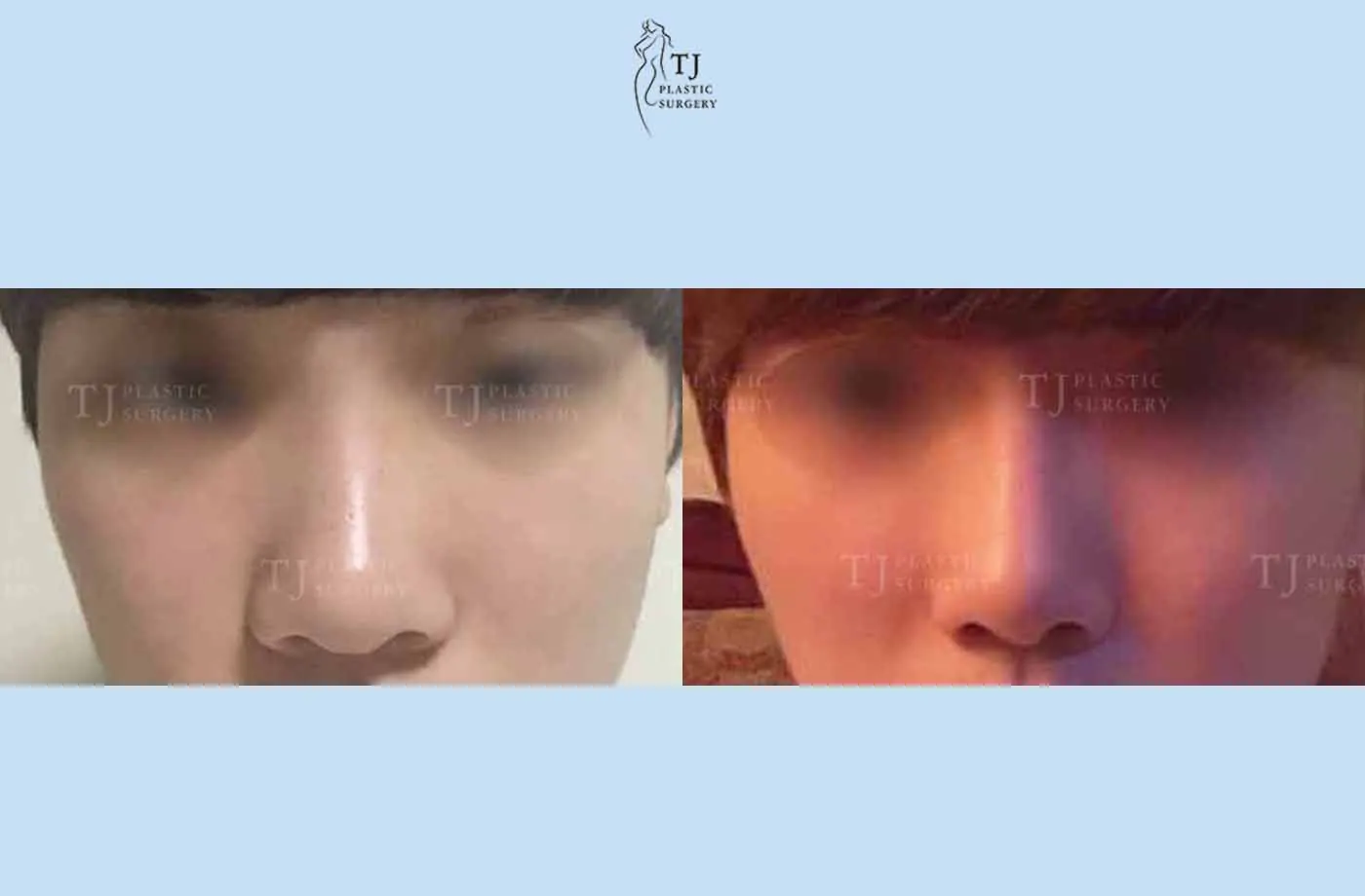 Rhinoplasty at TJ Plastic Surgery Clinic — Front view; before on the left · after on the right