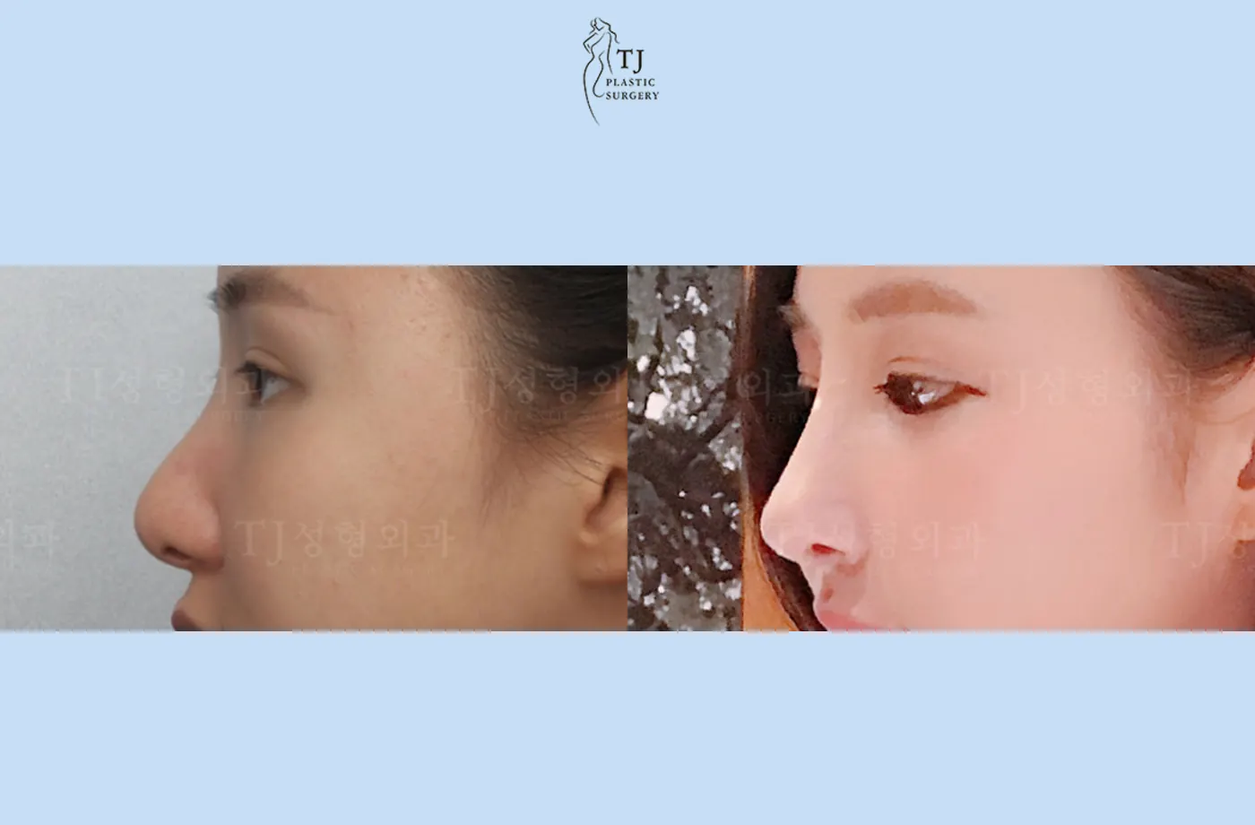 Rhinoplasty at TJ Plastic Surgery Clinic — Side view; before on the left · after on the right
