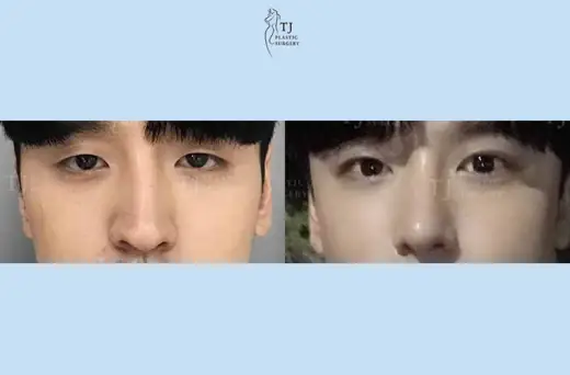 Rhinoplasty — front view before and after at TJ Plastic Surgery Clinic