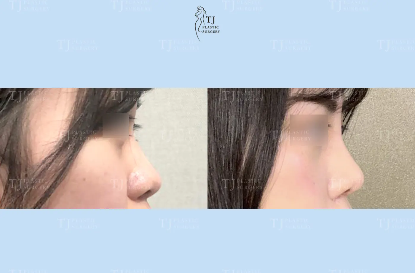 Rhinoplasty at TJ Plastic Surgery Clinic — Side view; before on the left · after on the right