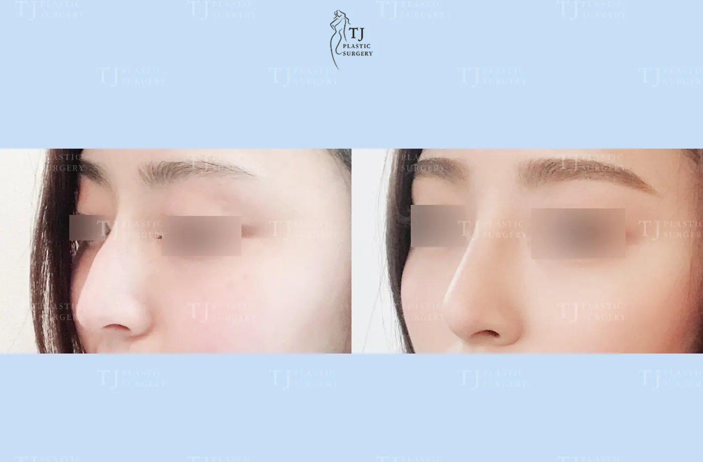 Rhinoplasty at TJ Plastic Surgery Clinic — Angled view; before on the left · after on the right