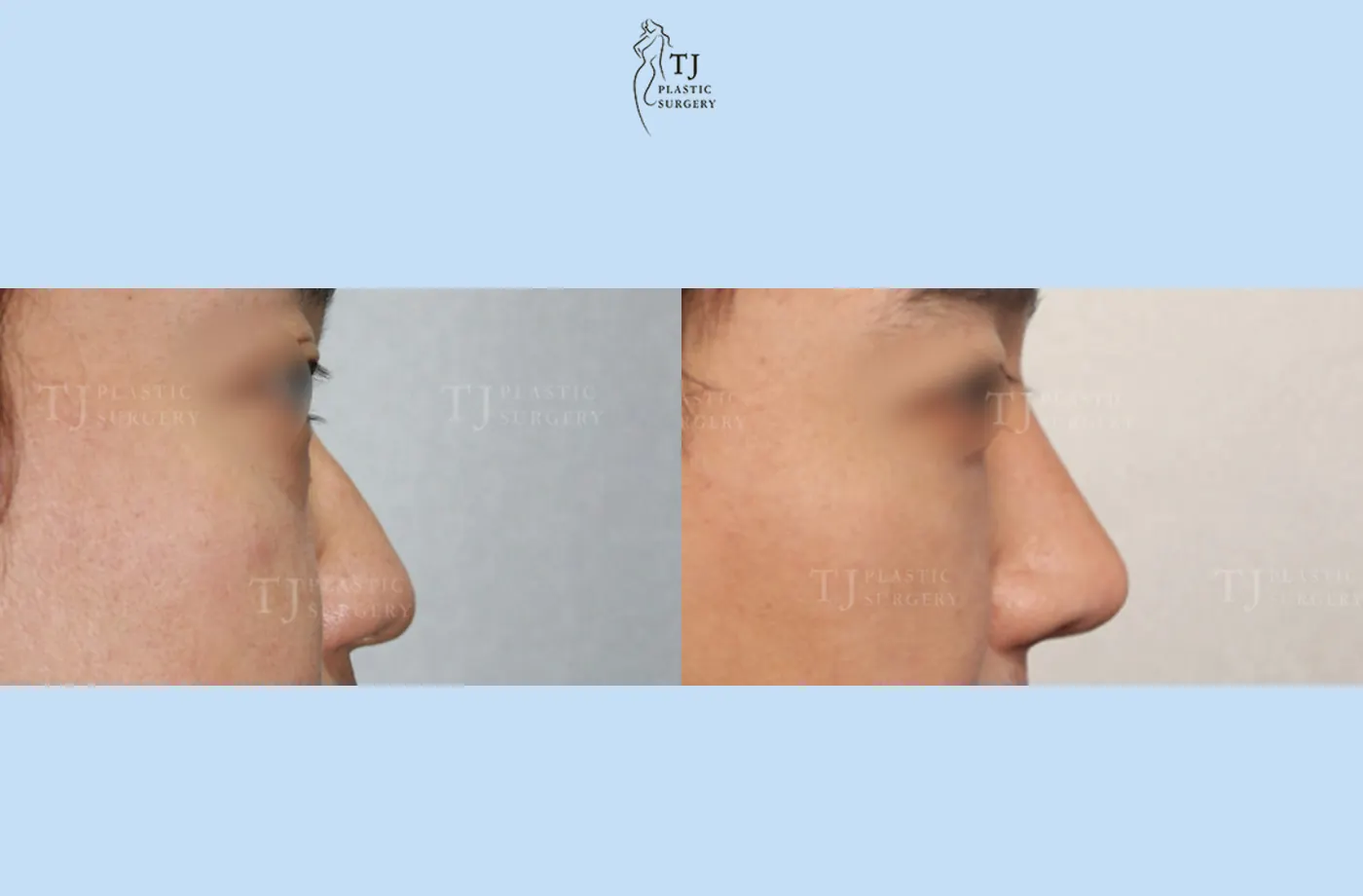 Rhinoplasty at TJ Plastic Surgery Clinic — Side view; before on the left · after on the right