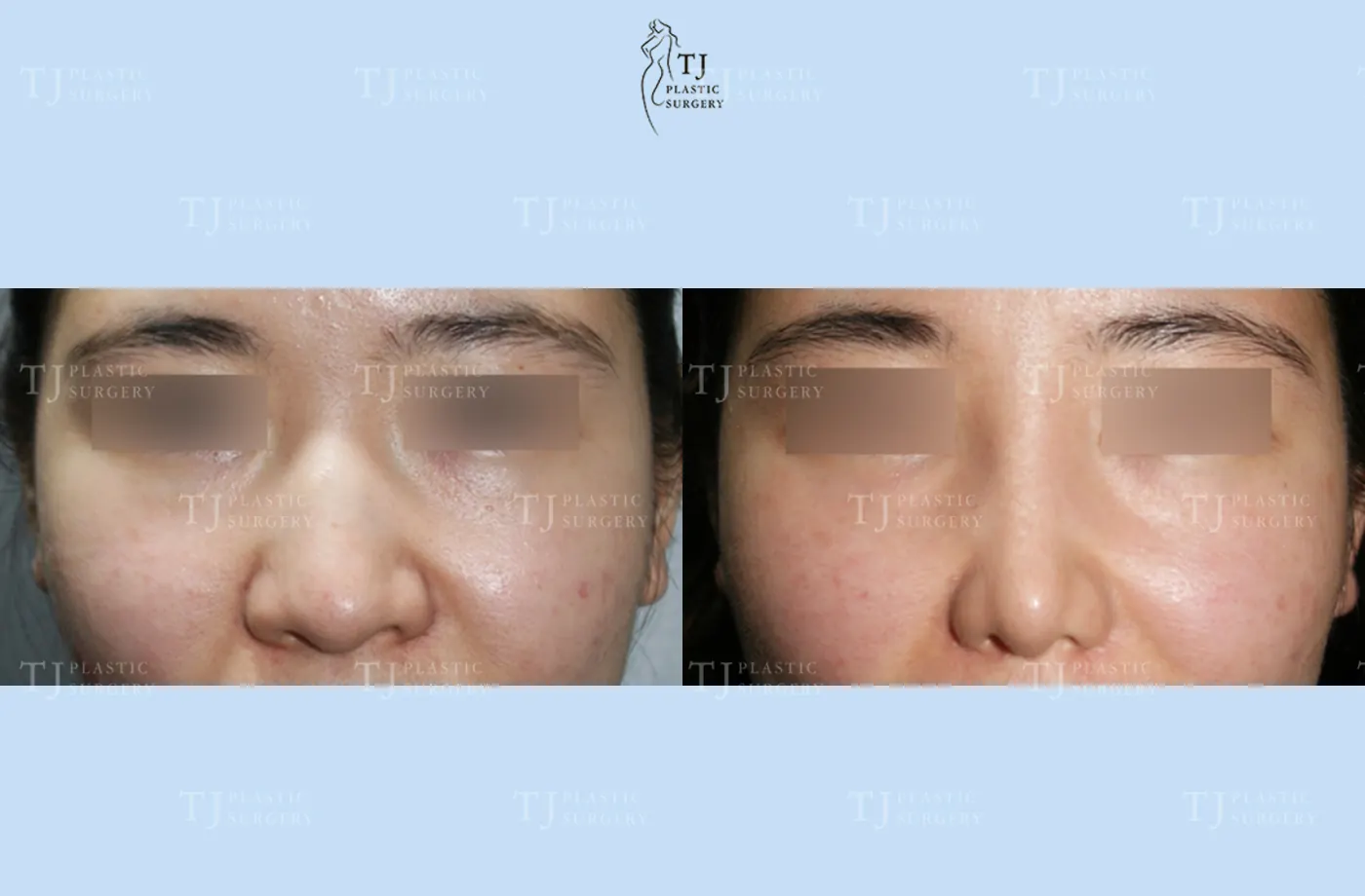 Rhinoplasty at TJ Plastic Surgery Clinic — Front view; before on the left · after 1 month