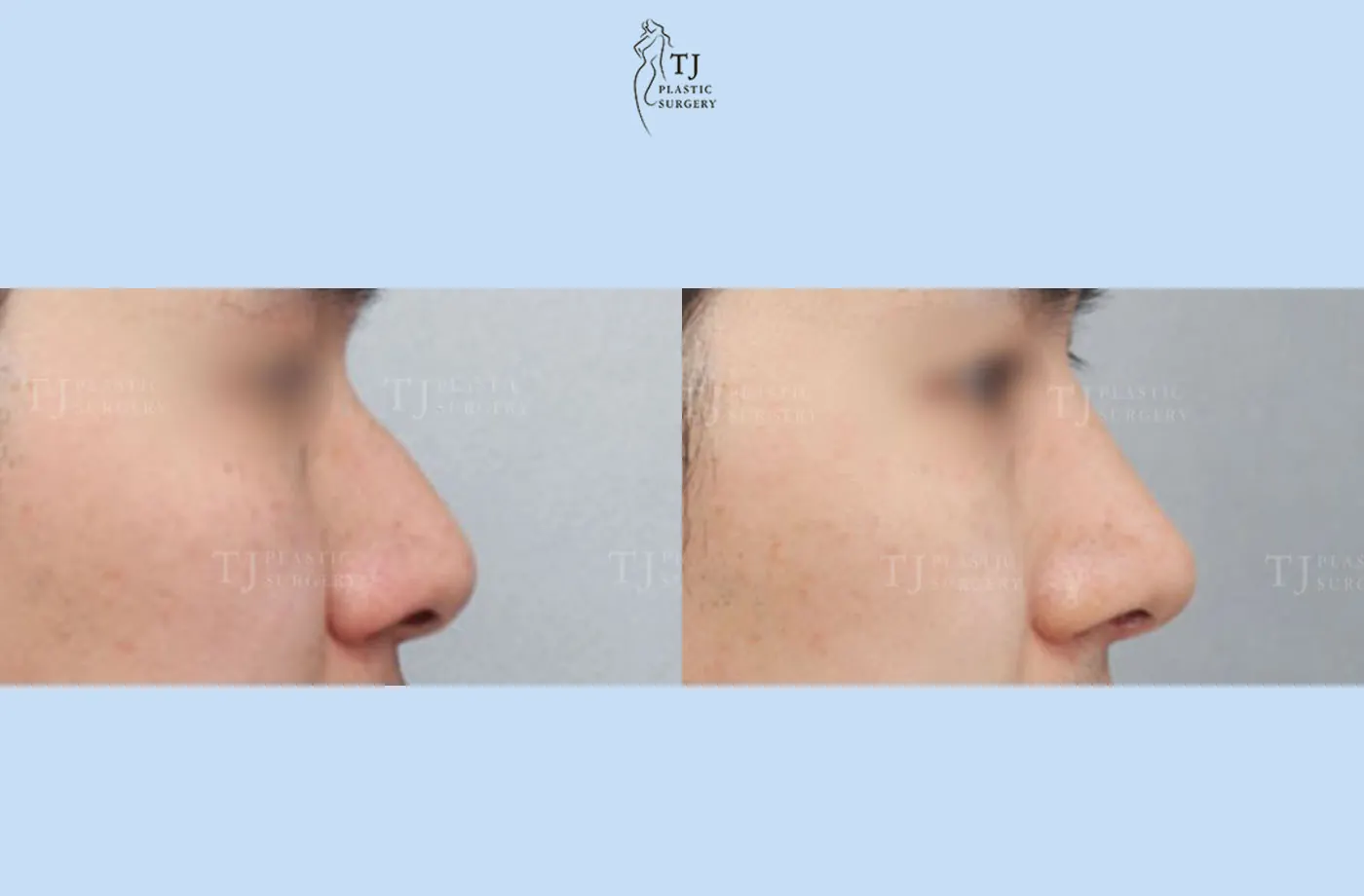Rhinoplasty at TJ Plastic Surgery Clinic — Side view; before on the left · after on the right