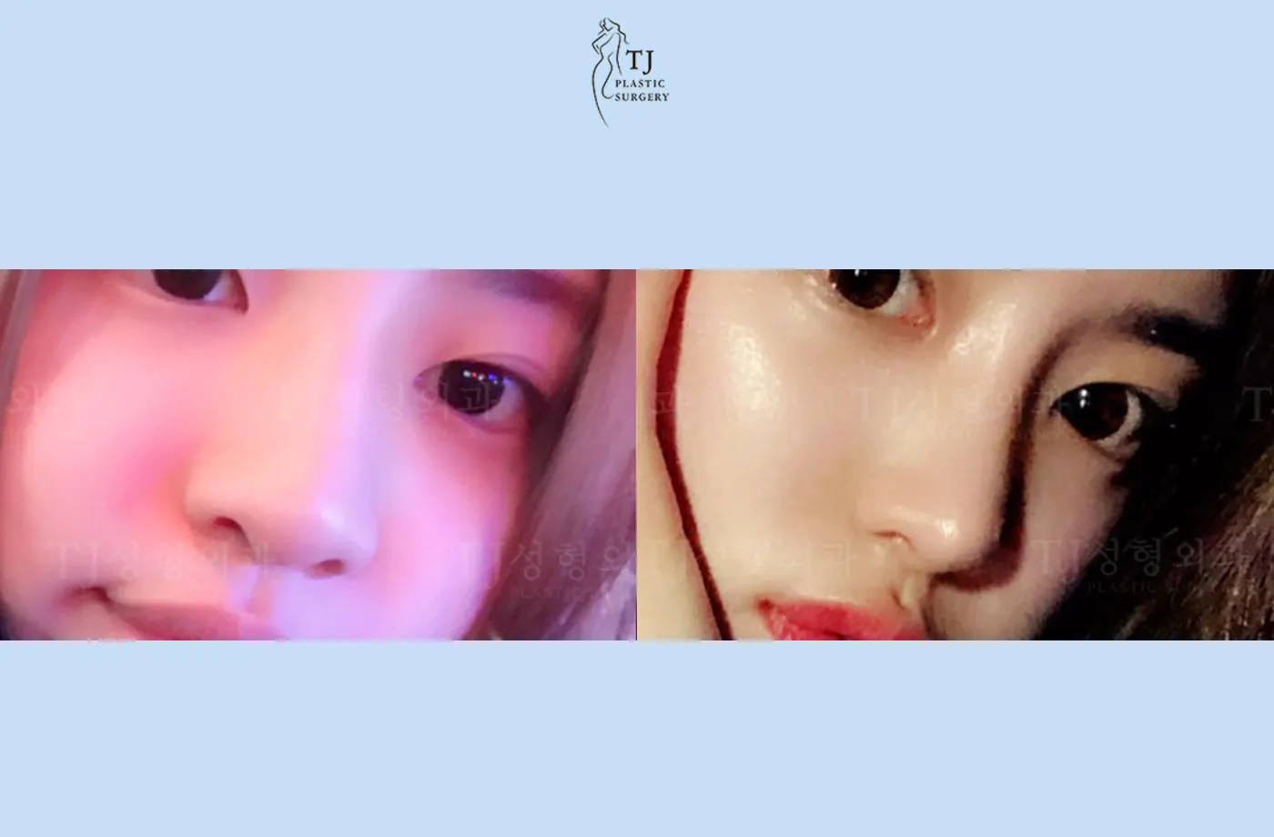 Rhinoplasty at TJ Plastic Surgery Clinic — Angled view; before on the left · after on the right