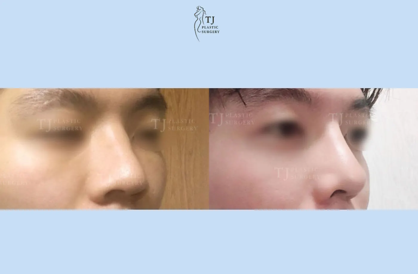 Rhinoplasty at TJ Plastic Surgery Clinic — Angled view; before on the left · after on the right