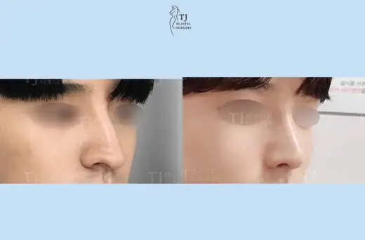 Rhinoplasty — angled view before and after at TJ Plastic Surgery Clinic