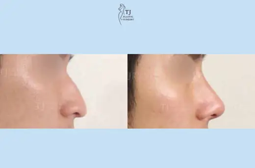 Rhinoplasty — side view before and after at TJ Plastic Surgery Clinic