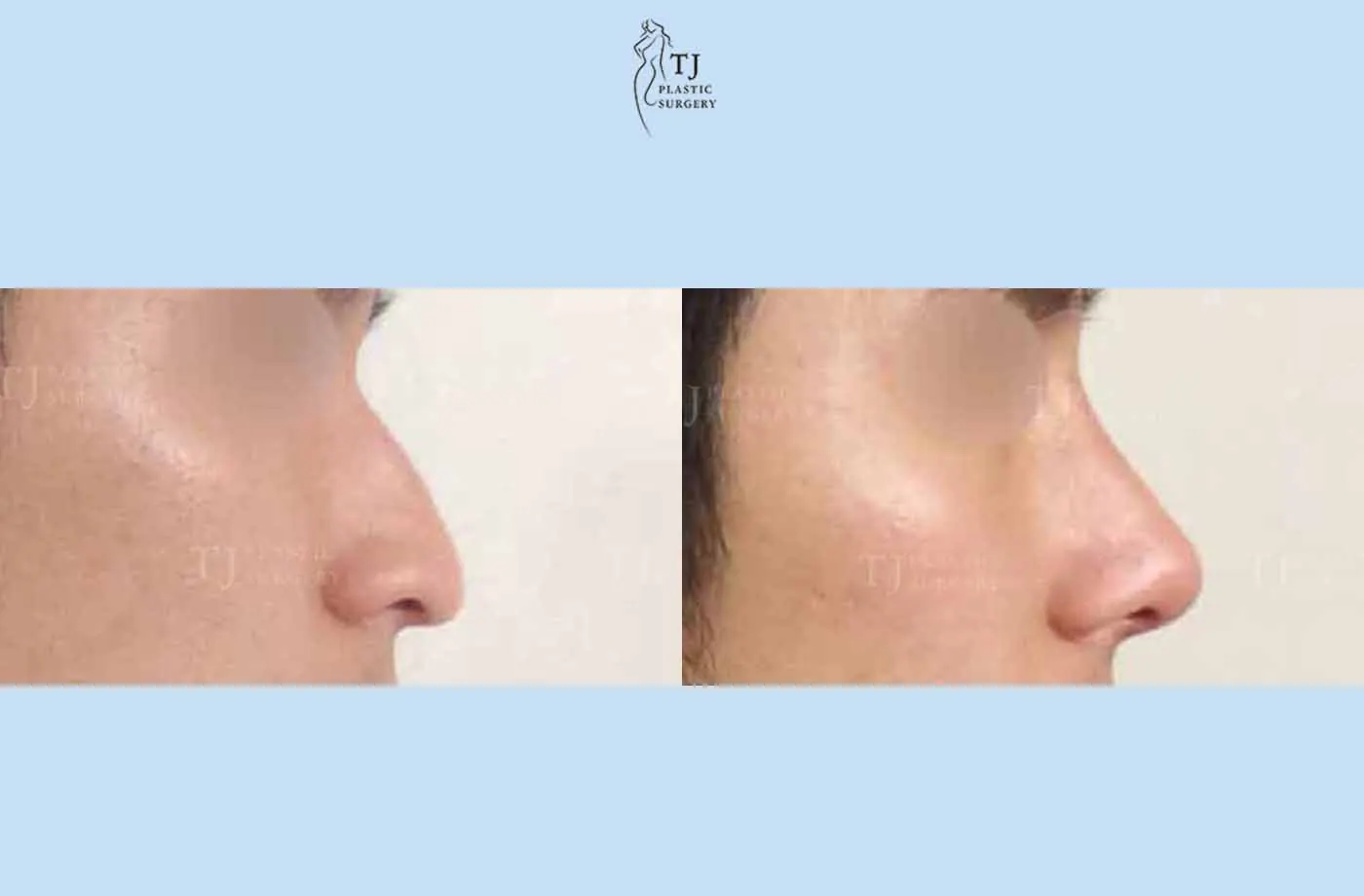 Rhinoplasty at TJ Plastic Surgery Clinic — Side view; before on the left · after on the right