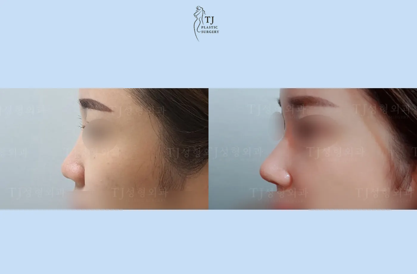 Rhinoplasty at TJ Plastic Surgery Clinic — Side view; before on the left · after on the right