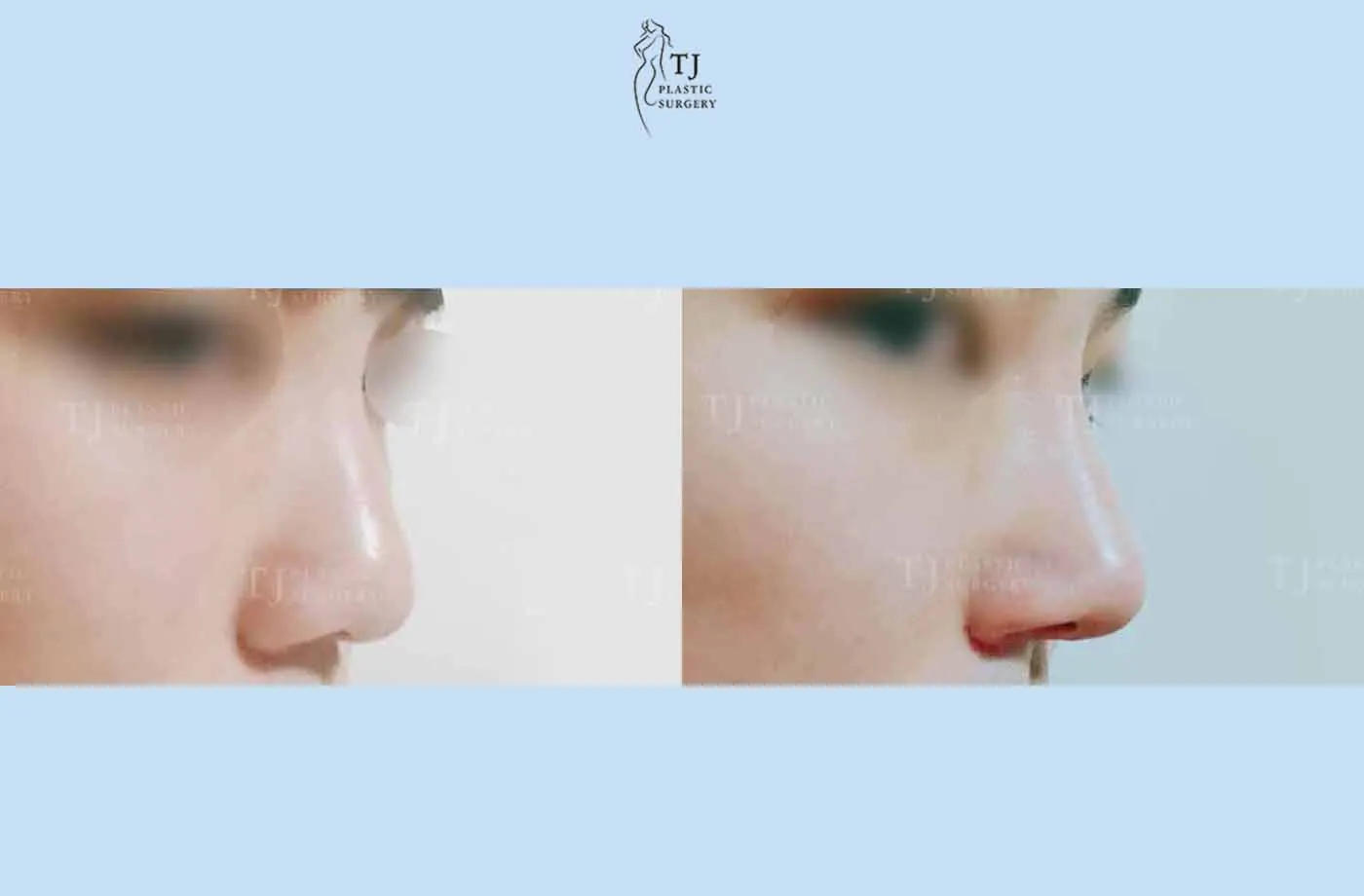 Rhinoplasty at TJ Plastic Surgery Clinic — Side view; before on the left · after on the right
