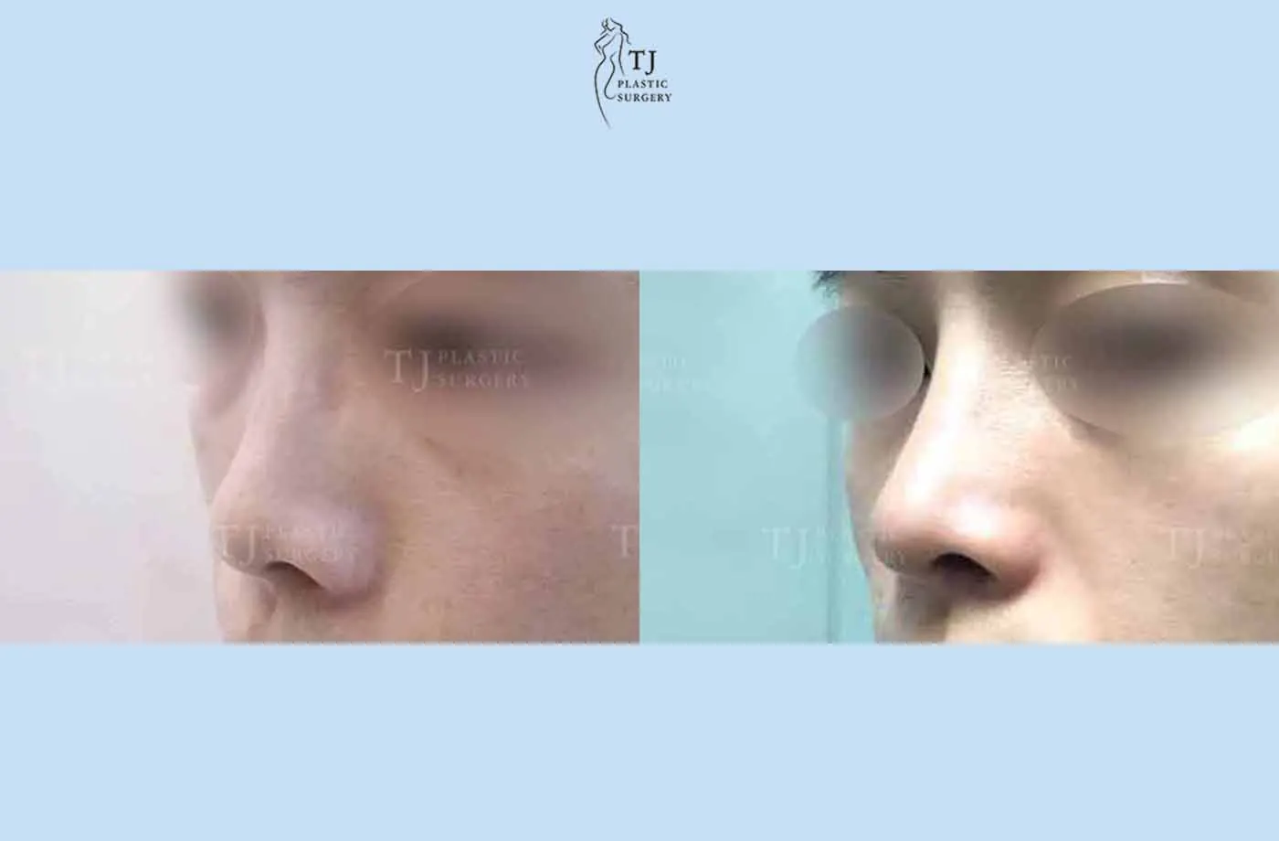 Rhinoplasty at TJ Plastic Surgery Clinic — Angled view; before on the left · after on the right