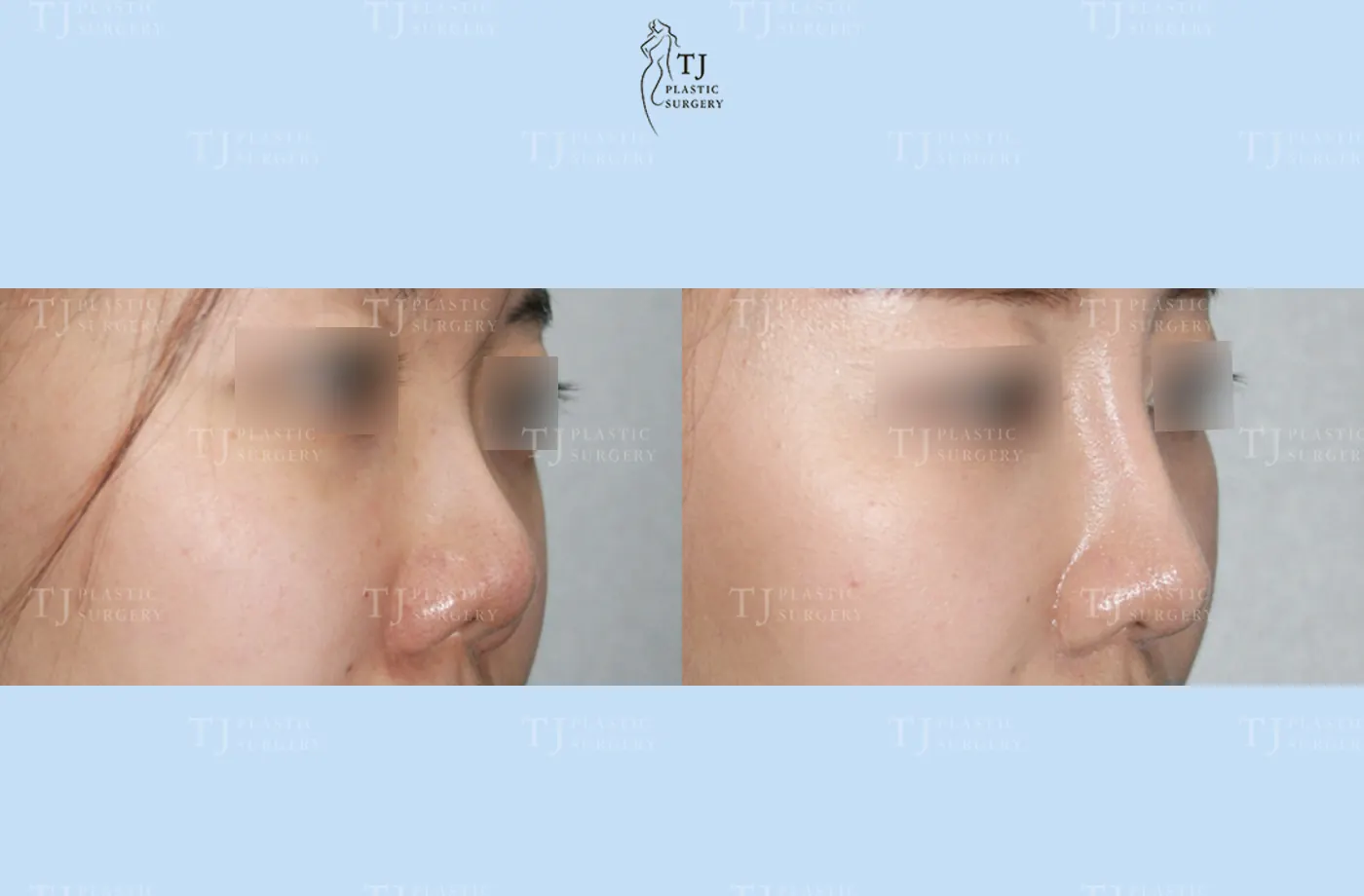 Rhinoplasty at TJ Plastic Surgery Clinic — Side view; before on the left · after on the right
