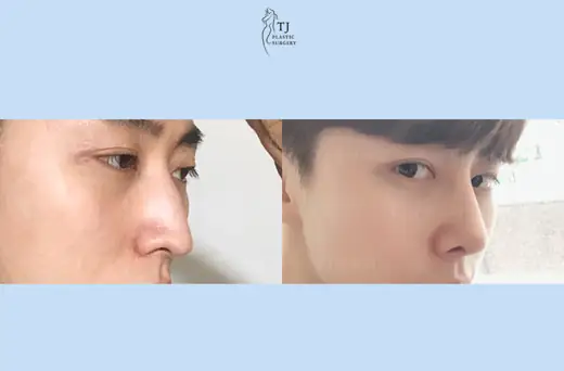 Rhinoplasty — angled view before and after at TJ Plastic Surgery Clinic