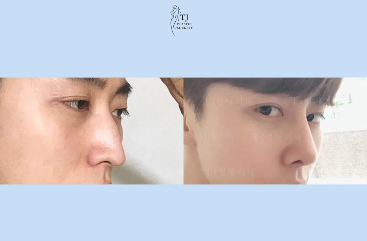 Rhinoplasty at TJ Plastic Surgery Clinic — Angled view; before on the left · after on the right