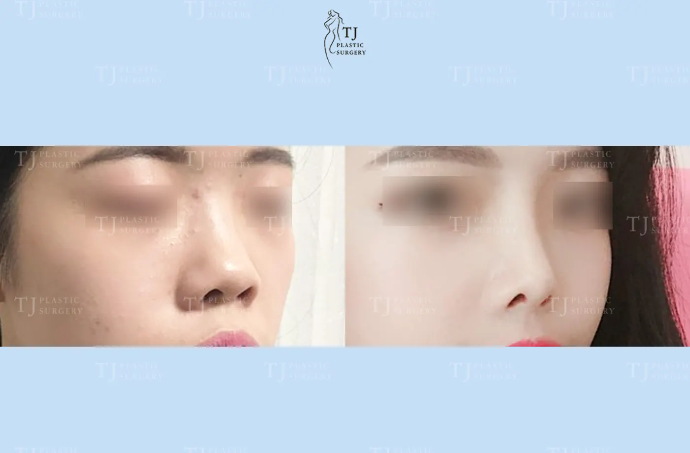 Rhinoplasty at TJ Plastic Surgery Clinic — Angled view; before on the left · after on the right