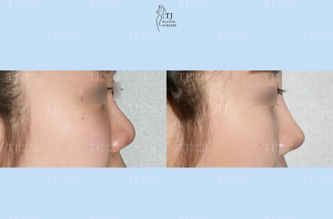 Rhinoplasty at TJ Plastic Surgery Clinic — Side view; before on the left · after on the right