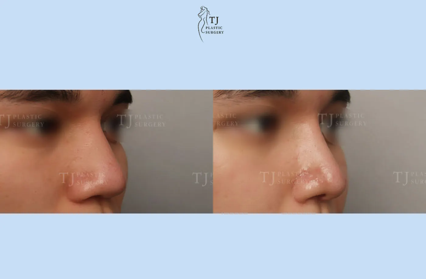 Rhinoplasty at TJ Plastic Surgery Clinic — Side view; before on the left · after on the right