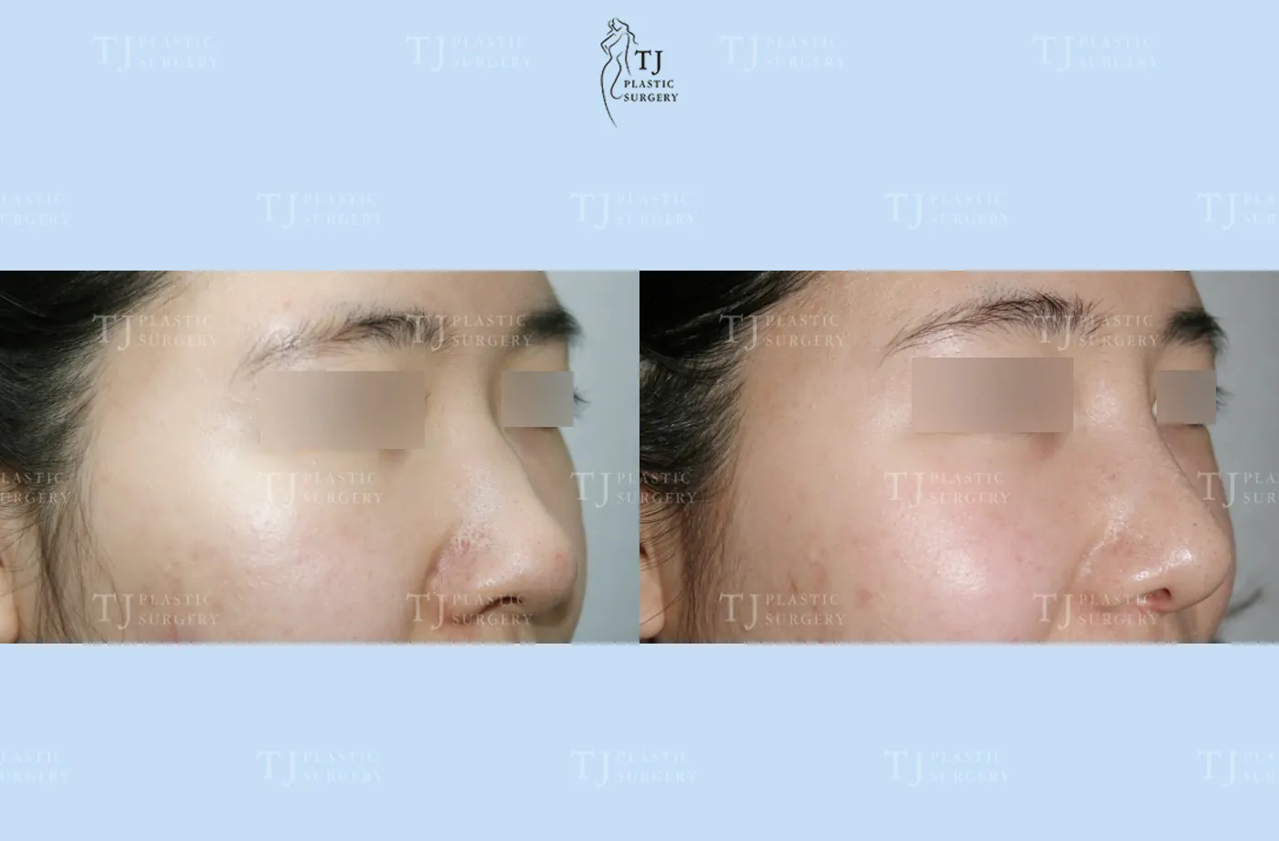 Rhinoplasty at TJ Plastic Surgery Clinic — Angled view; before on the left · after 1 month