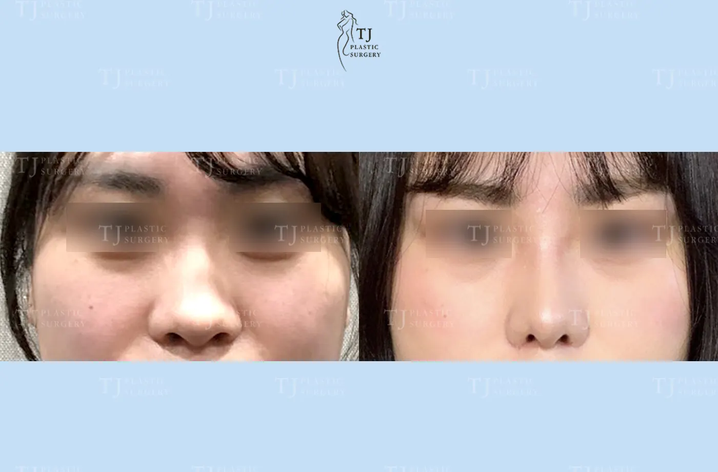 Rhinoplasty at TJ Plastic Surgery Clinic — Front view; before on the left · after on the right