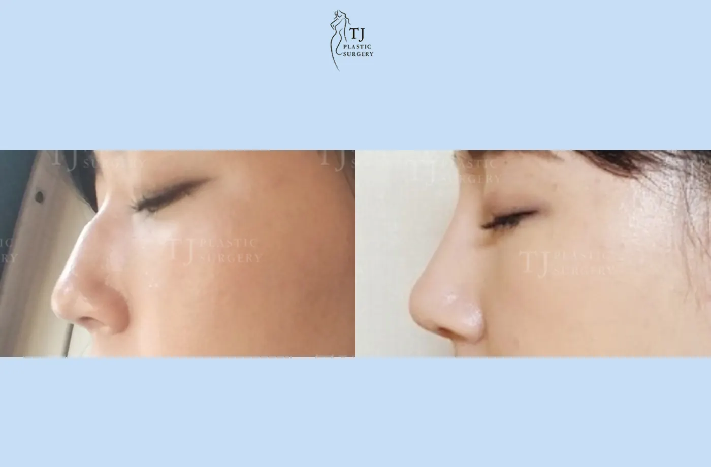 Rhinoplasty at TJ Plastic Surgery Clinic — Side view; before on the left · after on the right