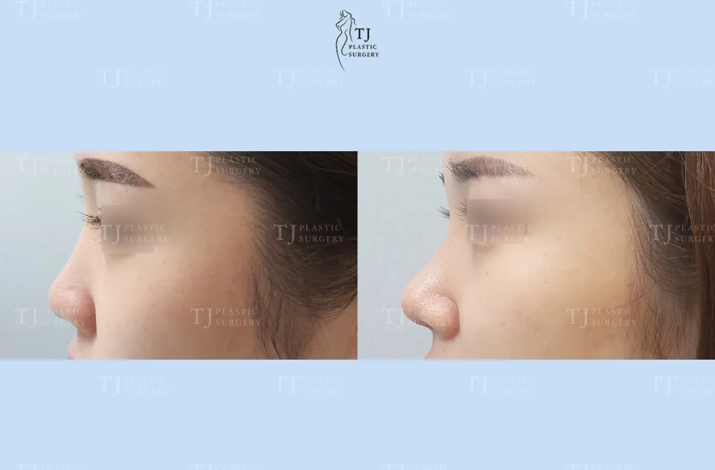 Rhinoplasty at TJ Plastic Surgery Clinic — Side view; before on the left · after on the right