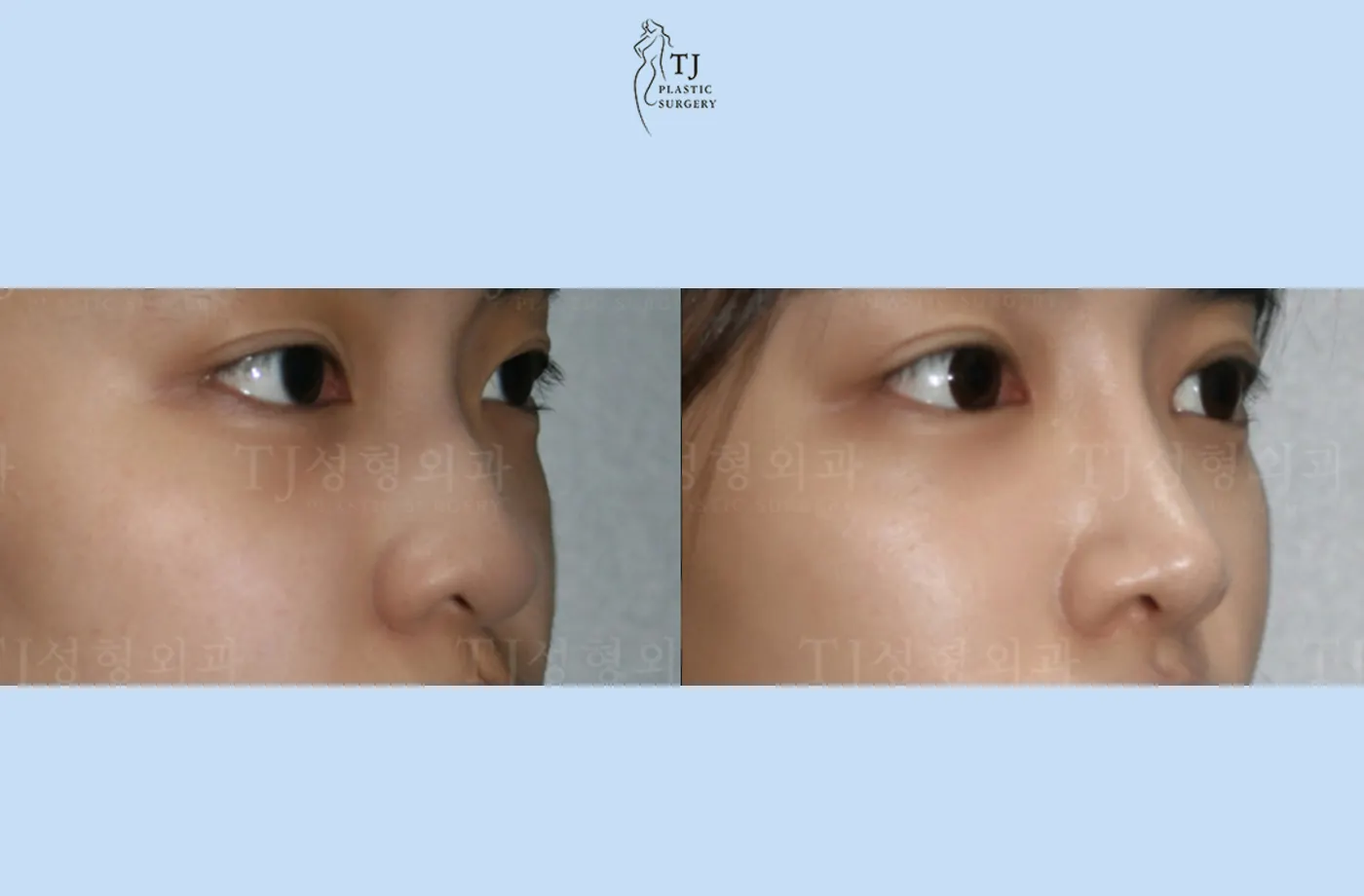 Rhinoplasty at TJ Plastic Surgery Clinic — Angled view; before on the left · after on the right