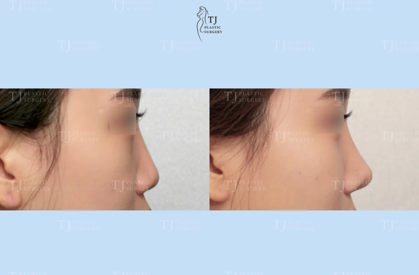 Rhinoplasty at TJ Plastic Surgery Clinic — Side view; before on the left · after on the right