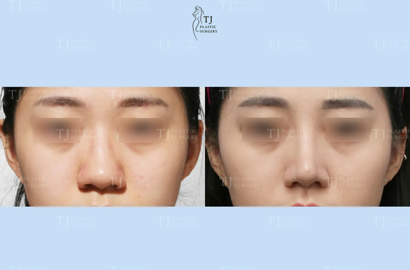Rhinoplasty at TJ Plastic Surgery Clinic — Front view; before on the left · after on the right
