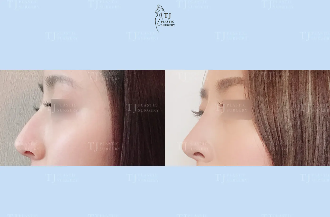 Rhinoplasty at TJ Plastic Surgery Clinic — Side view; before on the left · after on the right