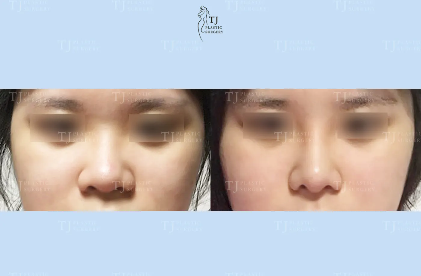 Rhinoplasty at TJ Plastic Surgery Clinic — Front view; before on the left · after on the right