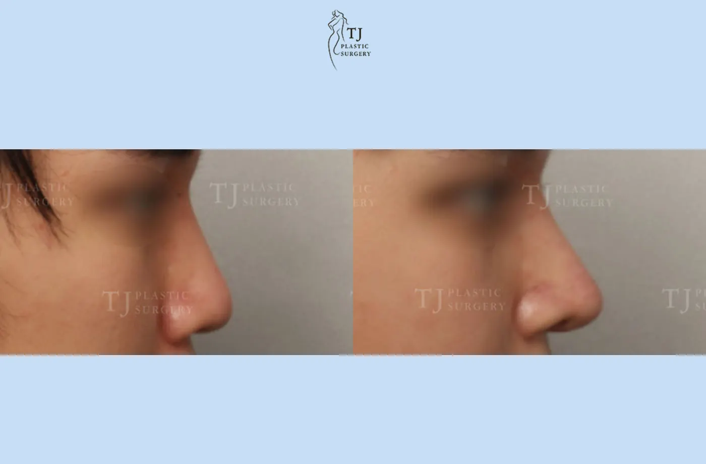 Rhinoplasty at TJ Plastic Surgery Clinic — Side view; before on the left · after on the right