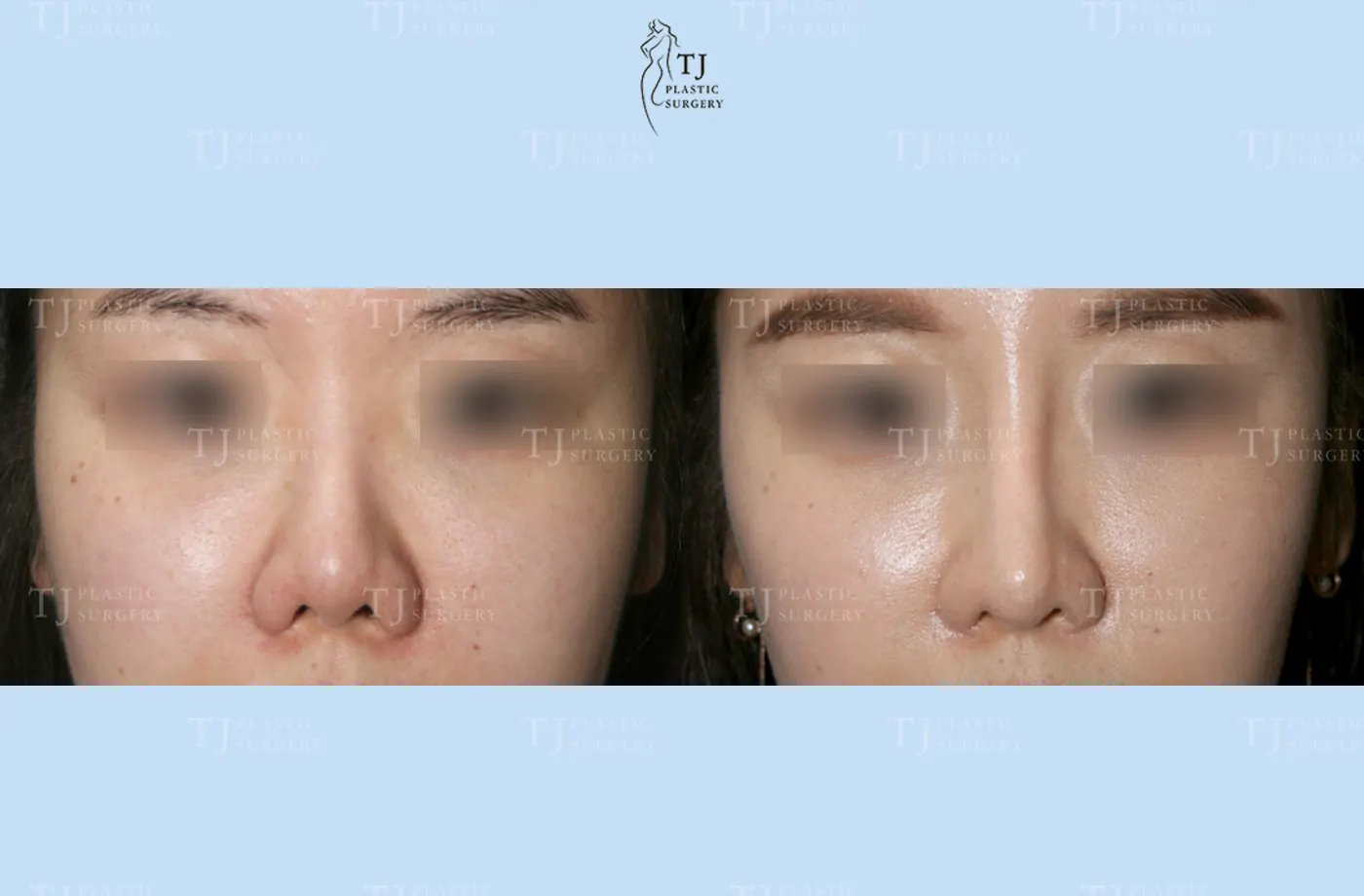 Rhinoplasty at TJ Plastic Surgery Clinic — Front view; before on the left · after on the right