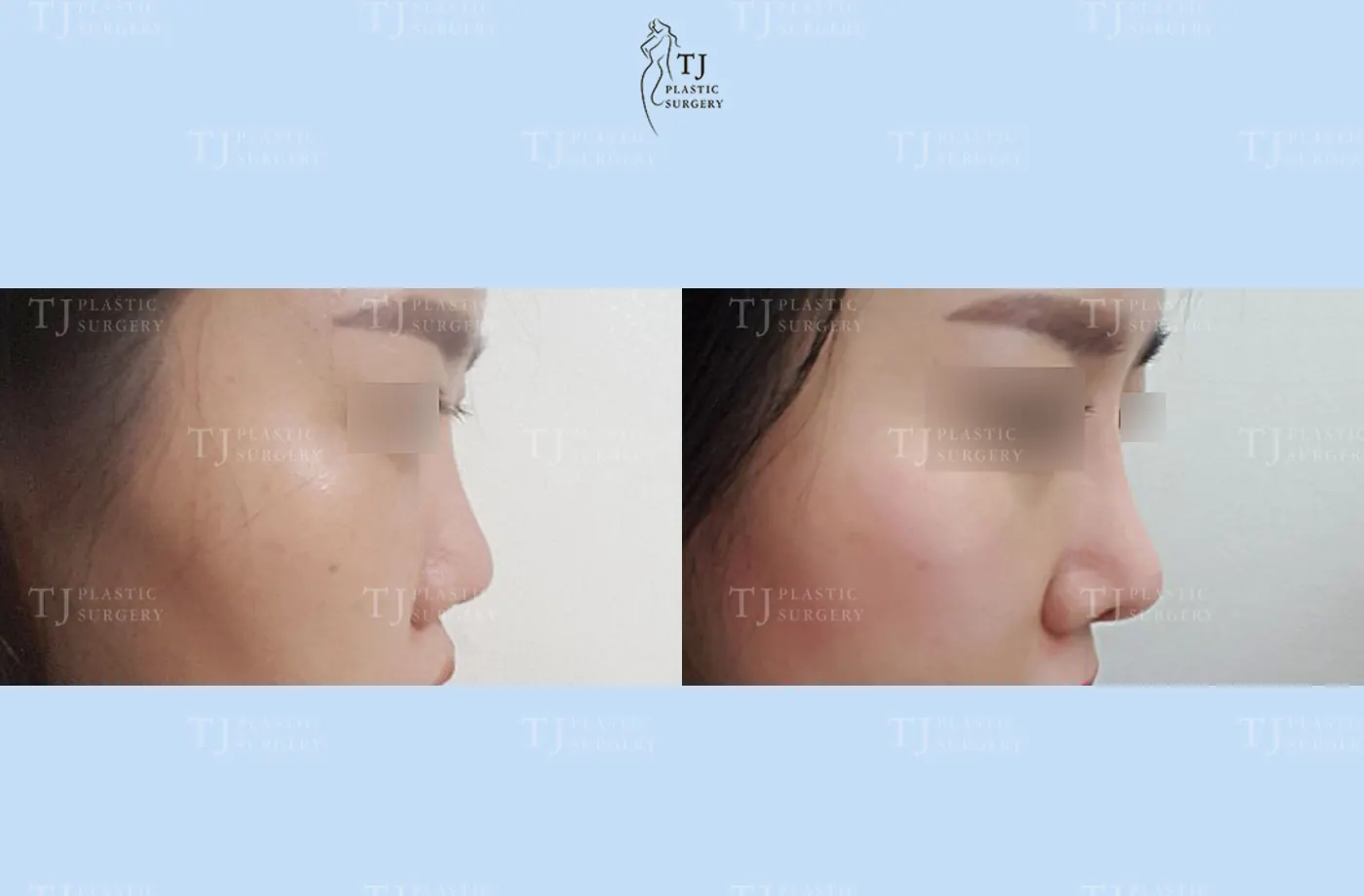 Rhinoplasty at TJ Plastic Surgery Clinic — Side view; before on the left · after on the right