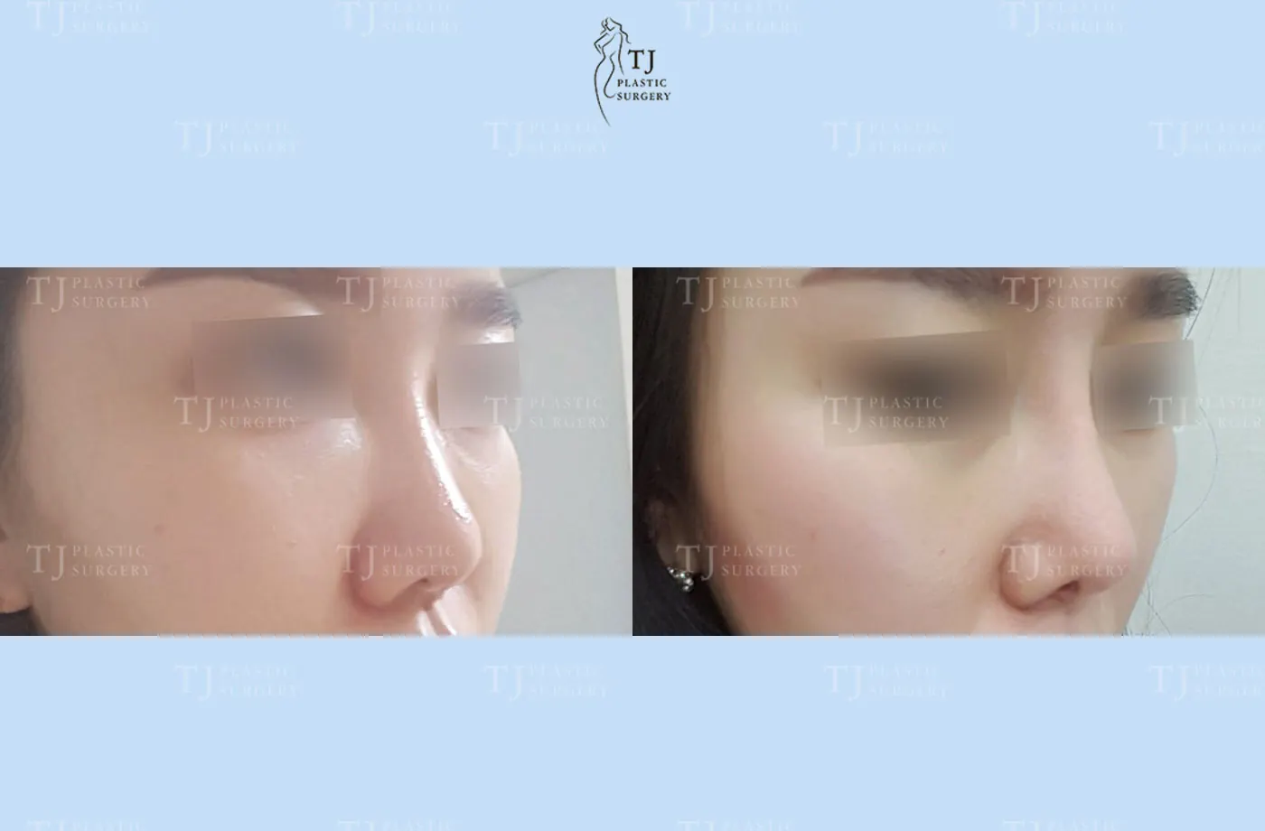 Rhinoplasty at TJ Plastic Surgery Clinic — Angled view; before on the left · after on the right