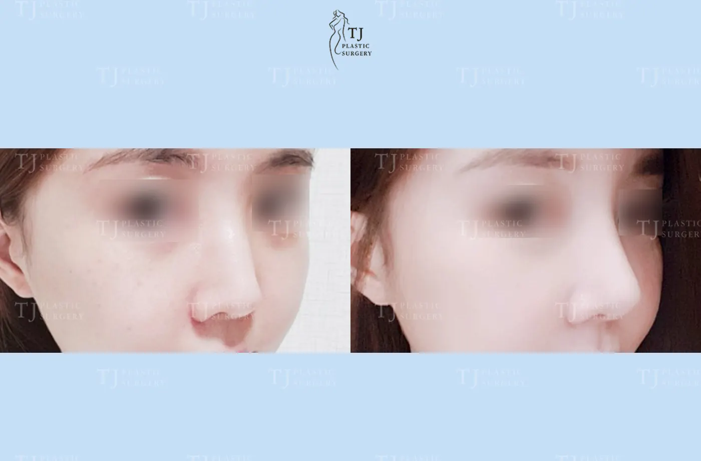 Rhinoplasty at TJ Plastic Surgery Clinic — Angled view; before on the left · after on the right
